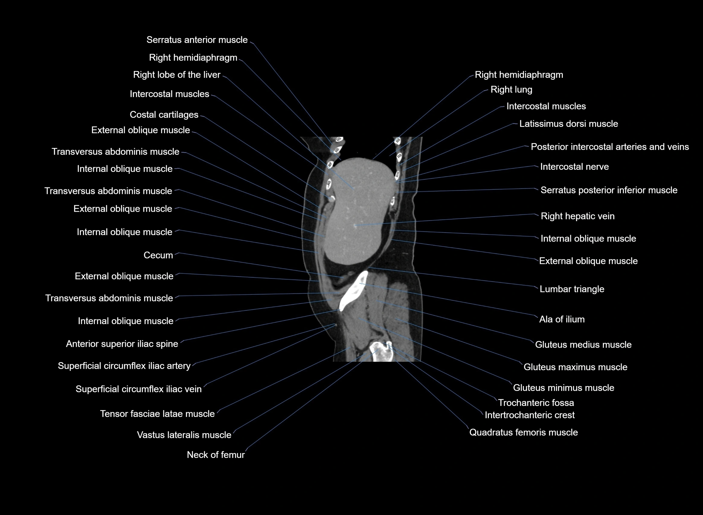 CT Abdomen sagittal cross sectional anatomy labelled radiology image -00096.webp
